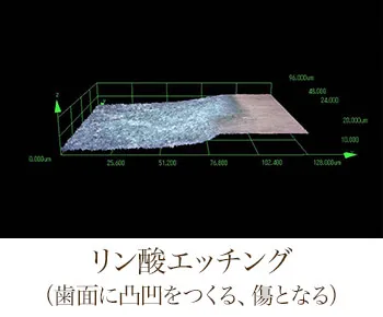 歯にやさしい接着技術