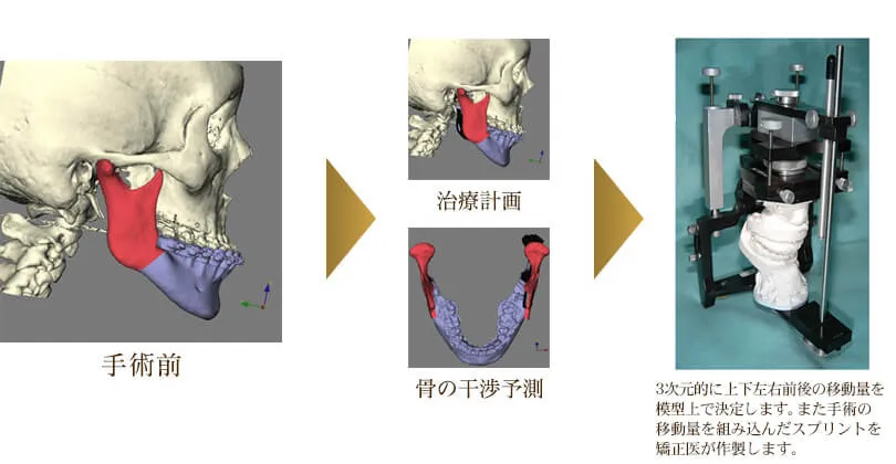 3DCTで咬合を主体にしたシミュレーションをするため正確な手術ができる